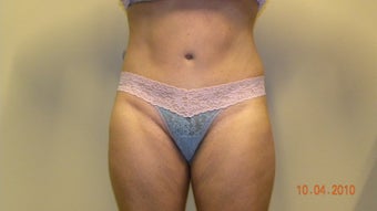 Abdominoplasty (Tummy-tuck) after 402723