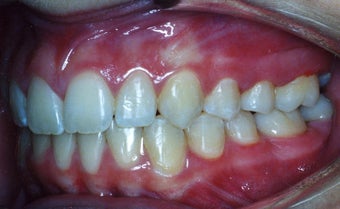 Orthodontic braces to correct a Class II malocclusion after 404703