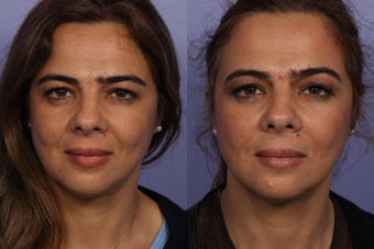 Radiesse to Smile Lines and Cheeks before 302271