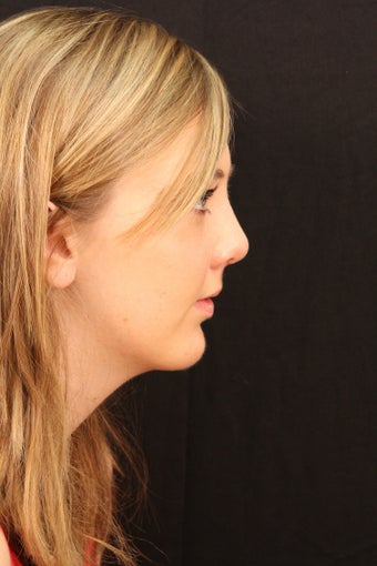 Rhinoplasty with chin augmentation after 248095