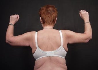 Brachioplasty (Arm Lift) after 358819