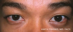 Male Asian Eyelid Surgery before 526428
