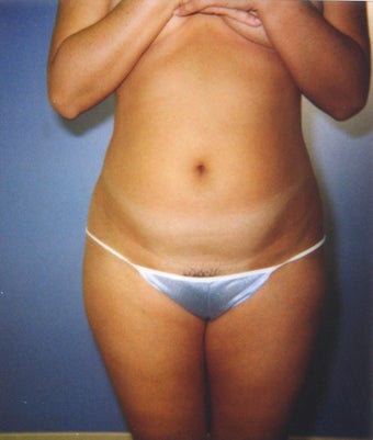 liposuction of abdomen and flanks of woman from Los Angeles before 583292