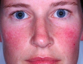 Laser treatment for rosacea before 374539
