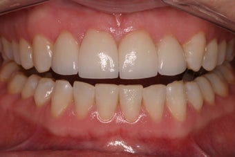 porcelain crowns to close space after 336722