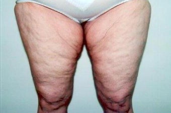 Medial Thigh Lift before 247666