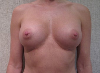 Breast Augmentation after 346178