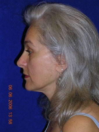 Facelift, Eyelid lift after 466424