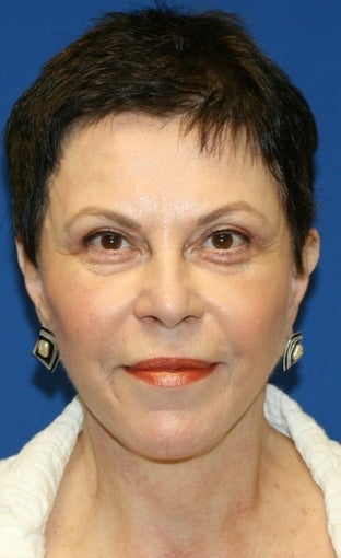 Facelift with Extended Necklift, Browlift, Fat Transfer, Upper Blepharoplasty, and Skin Pinch after 625450