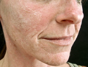 Mid Face and Lip Correction before 271681