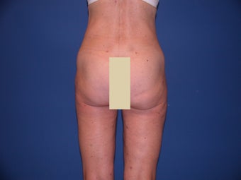 Thigh Liposculpture after 66003