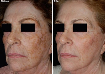 Fraxel Laser Resurfacing before 97774