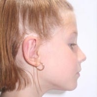 Otoplasty 443057