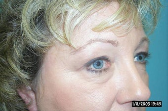 Upper and Lower Lid Blepharoplasty and Cheeklift before 148578