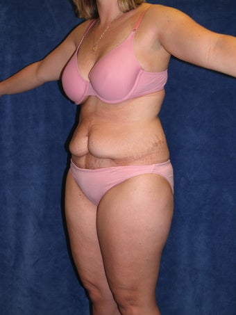 Tummy Tuck with Liposuction 411003