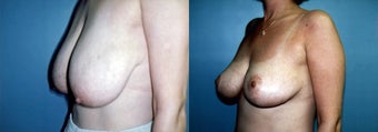 Breast Reduction & Mammoplasty before 352703