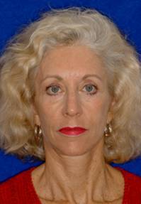 Facial Fat Grafting after 75980