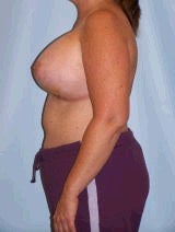 Revision Breast Surgery 370397