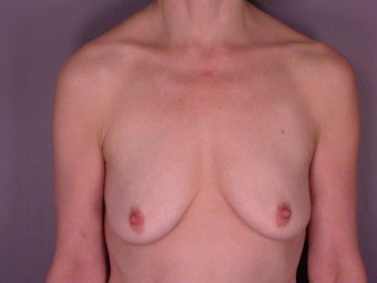 Breast Lift / Breast Augmentation before 291159