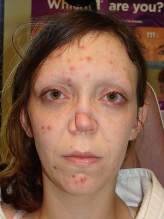 Rhinoplasty before 368032
