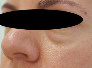 Restylane for eye bags before 199422