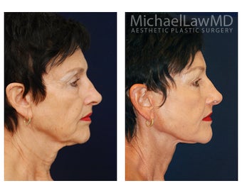 Facial Rejuvenation 395250