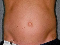 Liposonix before 582688