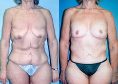 Upper Body & Back Lift After Major Weight Loss before 352826