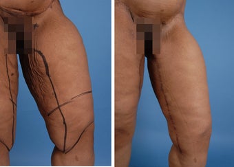 Thighplasty after 303693
