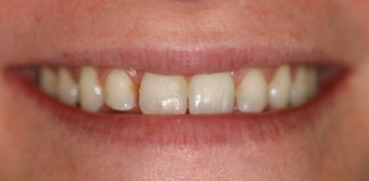 Orthodontics, all porcelain veneers before 503128