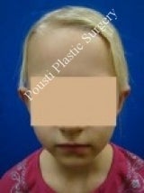 Ear Surgery (Otoplasty) after 579109