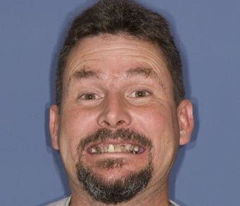 full mouth restoration before 363948