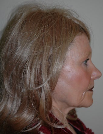 High SMAS Face Lift, Neck Lift, Perioral Dermabrasion 468008