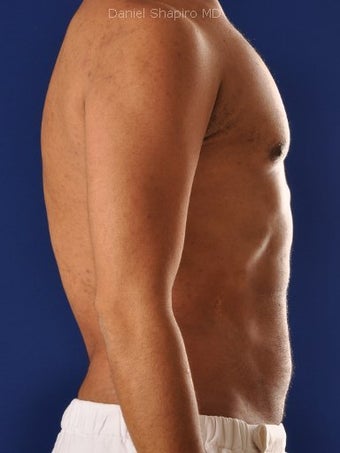 Vaser Hi Def Liposuction of the abdomen, chest, back, and flanks with fat injections to the pectoralis region 422699