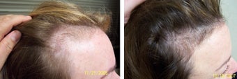 Female medical treatment for hair loss (no surgery) before 369186