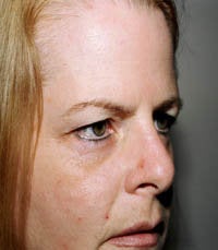 blepharoplasty (eyelids) before 219348