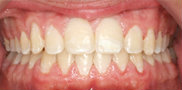 Two-Phase Orthodontic Treatment 344259
