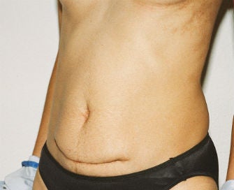 Abdominoplasty Revision 493649