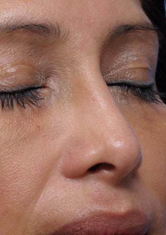 Non-Surgical Nose Job after 430195