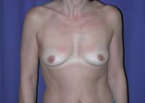 Breast Augmentation before 87562