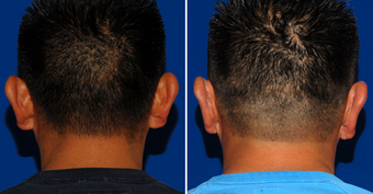 Ear Surgery after 495869