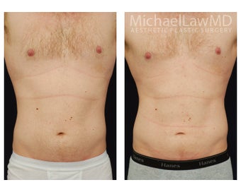 Liposuction before 392463