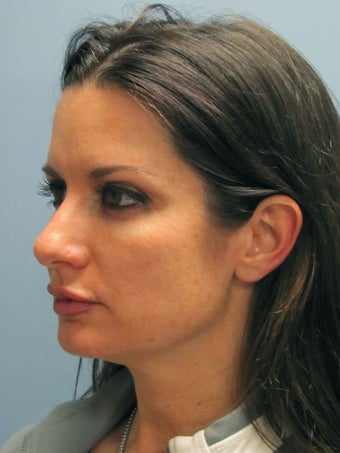 Neck Lift, Platysmaplasty 634730