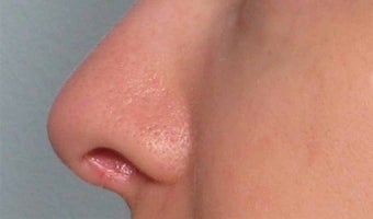 Juvederm in the nose after 343321