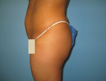 Buttock augmentation (Brazilian buttock lift) before 150355