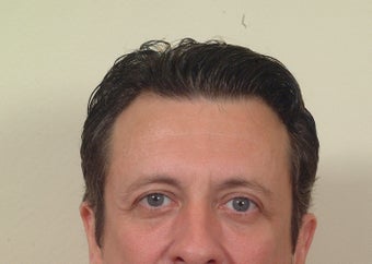 Cheek implants after 110408