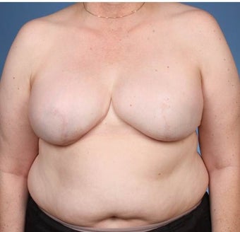 Breast Reconstruction after 539979