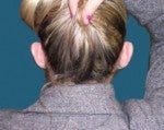 Ear Pinning before 519249
