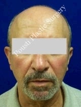 Ear Surgery (Otoplasty) 584571