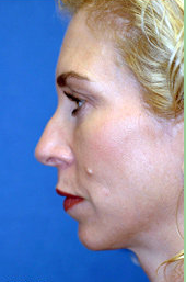 Chin Implant and Rhinoplasty before 324981